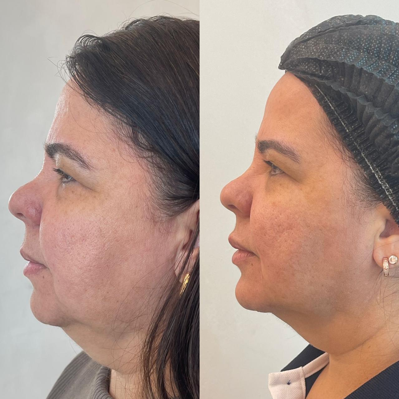 Antes e depois — Contorno & papada