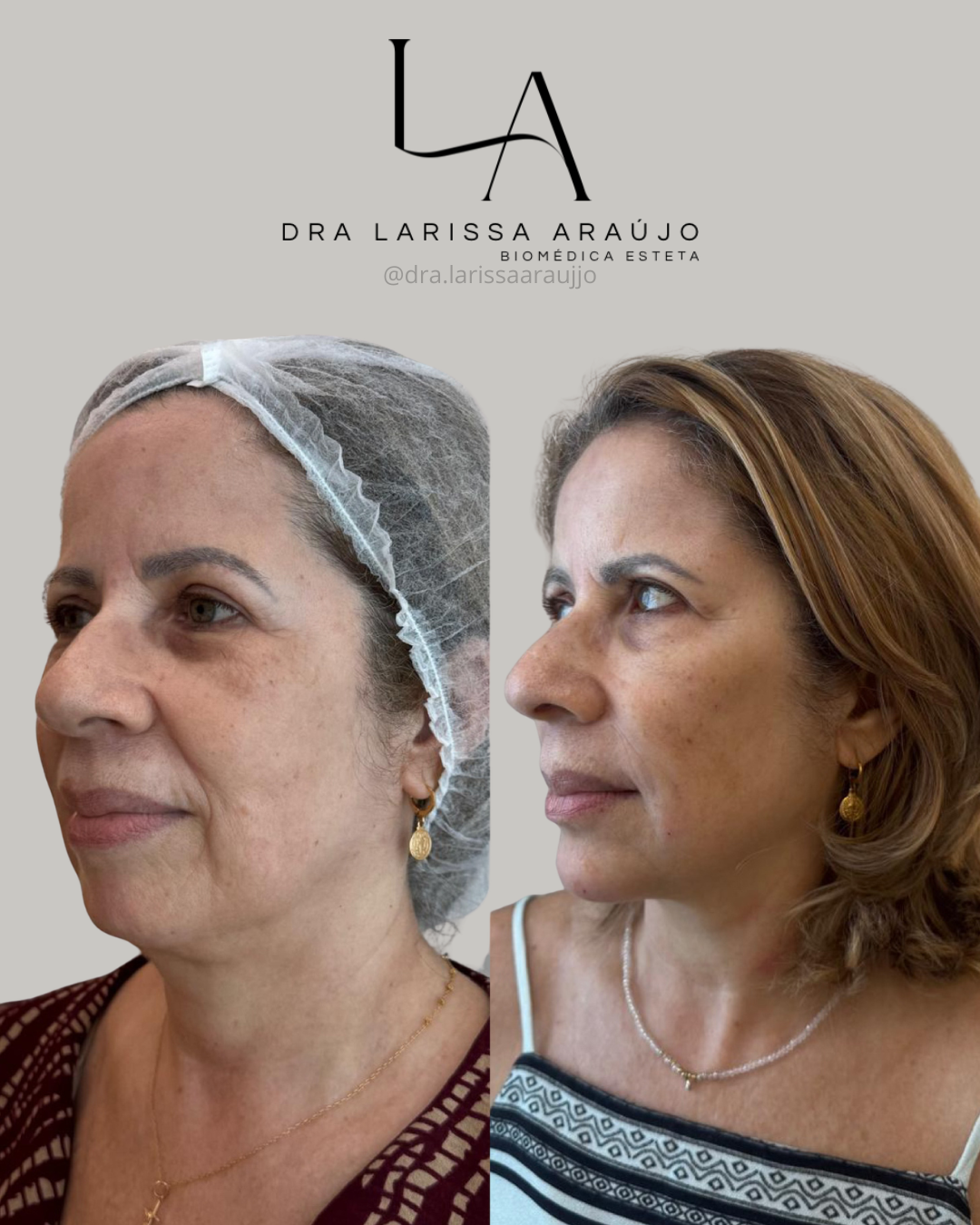 Antes e depois — Lifting não invasivo