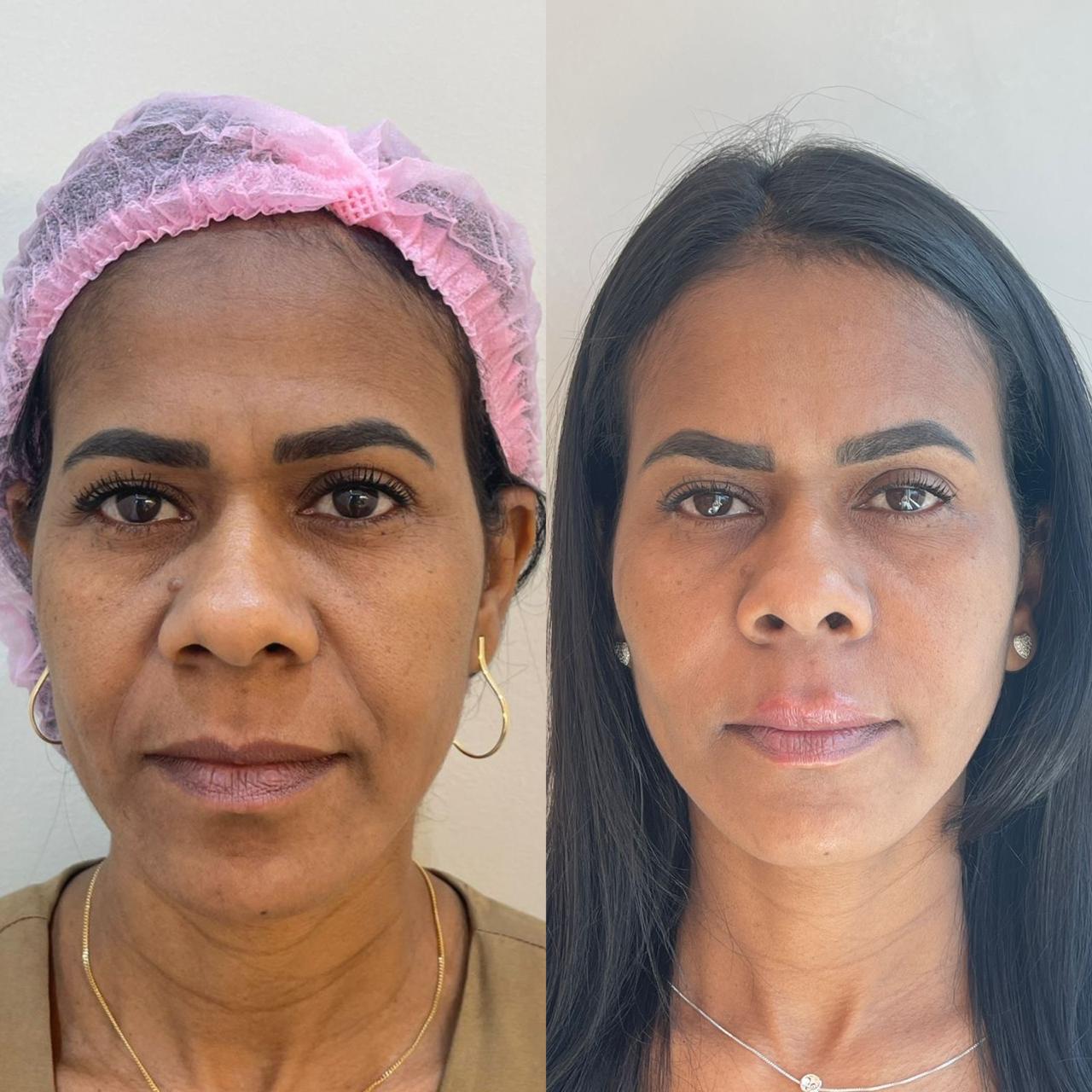 Antes e depois — Rejuvenescimento facial