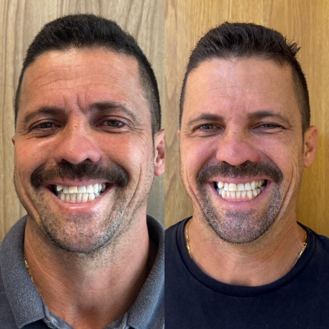 Antes e depois — Harmonização facial