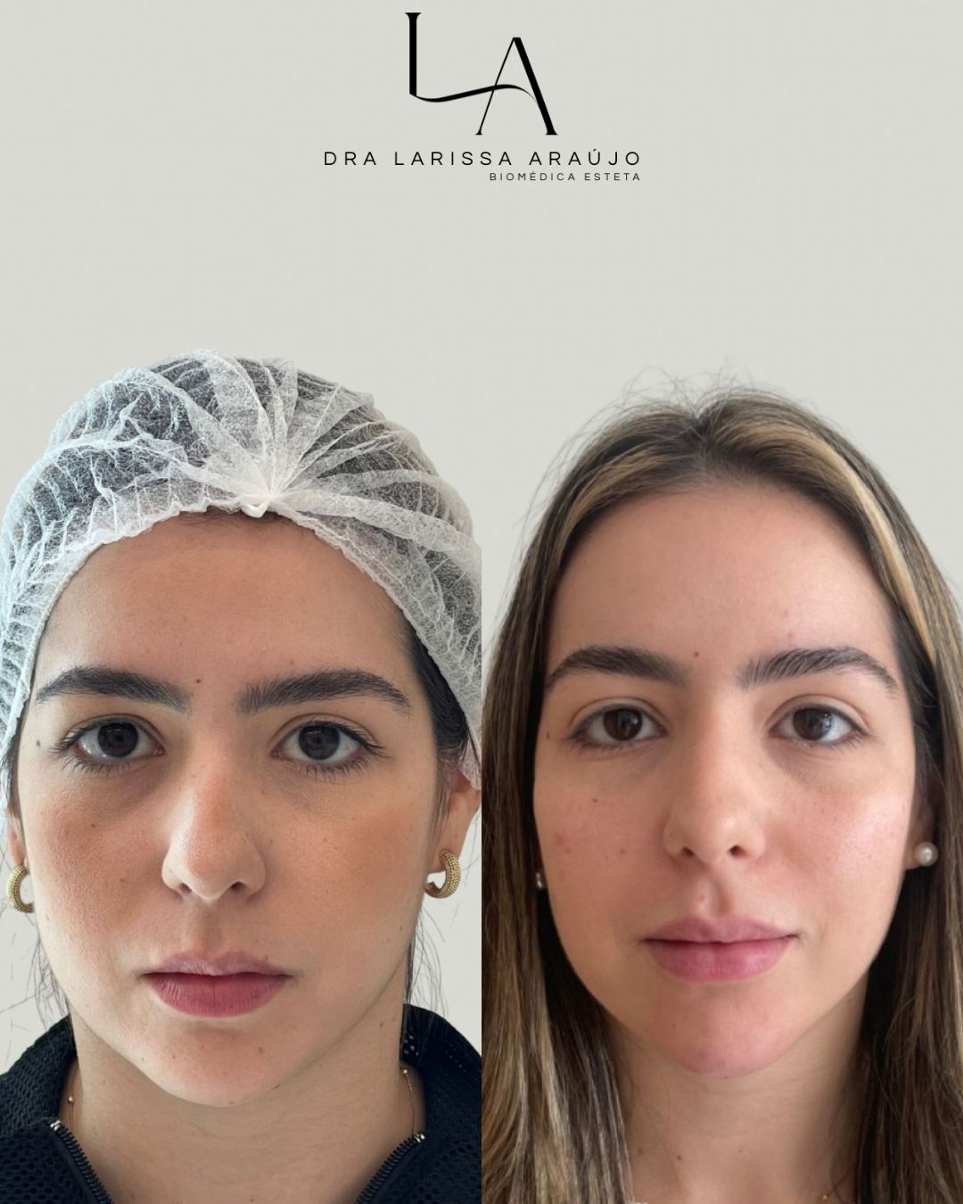 Antes e depois — Preenchimento labial