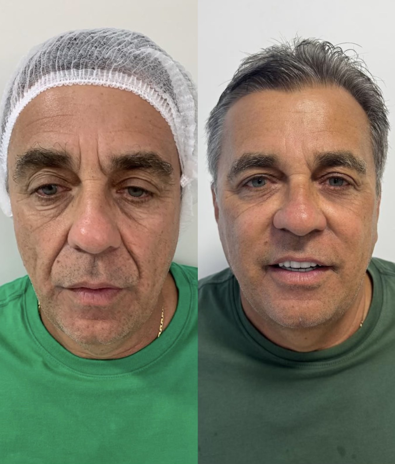 Antes e depois — Bioestimulador de colágeno